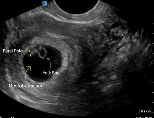 PEM POCUS Series: Pediatric First-Trimester Pregnancy
