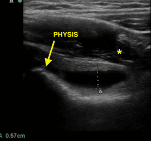 Hip effusion with anechoic fluid layering over the femoral neck measured to 5.7 mm, with femoral head, open physis (arrow), and iliopsoas muscle (asterisk) visible
