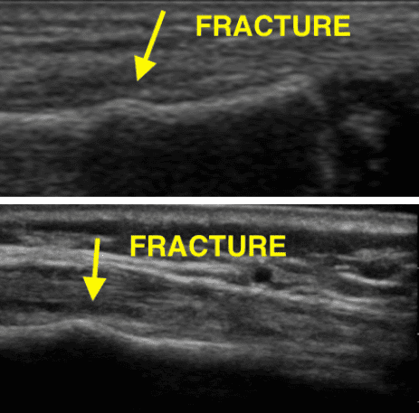 ultrasound finger fracture