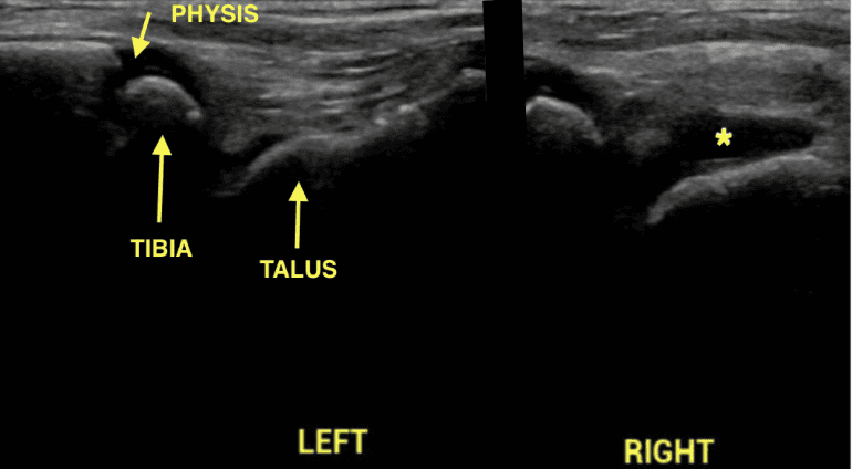 Bilateral ankle POCUS comparison with normal left tibiotalar joint and an asterisk marking anechoic effusion in the right tibiotalar joint