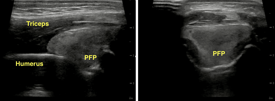 Elbow effusion on POCUS with elevated posterior fat pad (PFP) rising above the distal humeral line in longitudinal view (L) and above the olecranon fossa line in transverse view (R), pushing up on the triceps muscle