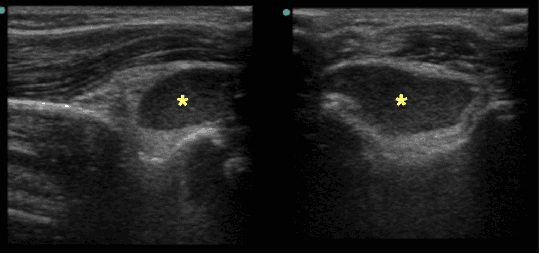 Elbow POCUS showing elevated posterior fat pad with lipohemarthrosis marked by yellow asterisks in longitudinal (L) and transverse (R) views