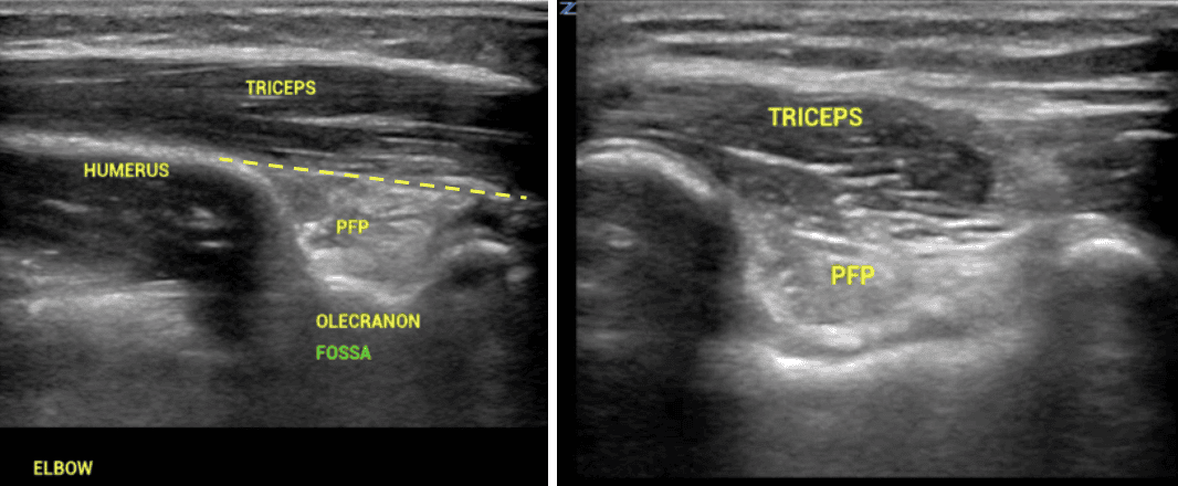 Normal elbow POCUS in longitudinal (L) and transverse (R) views showing the posterior fat pad (PFP) sitting below the distal humeral line in the olecranon fossa, with triceps muscle above and humerus below