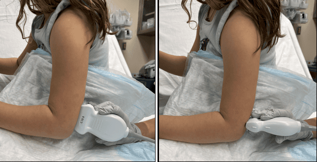 Linear ultrasound probe positioning on the posterior elbow in longitudinal (L) and transverse (R) orientations with the elbow flexed to 90 degrees