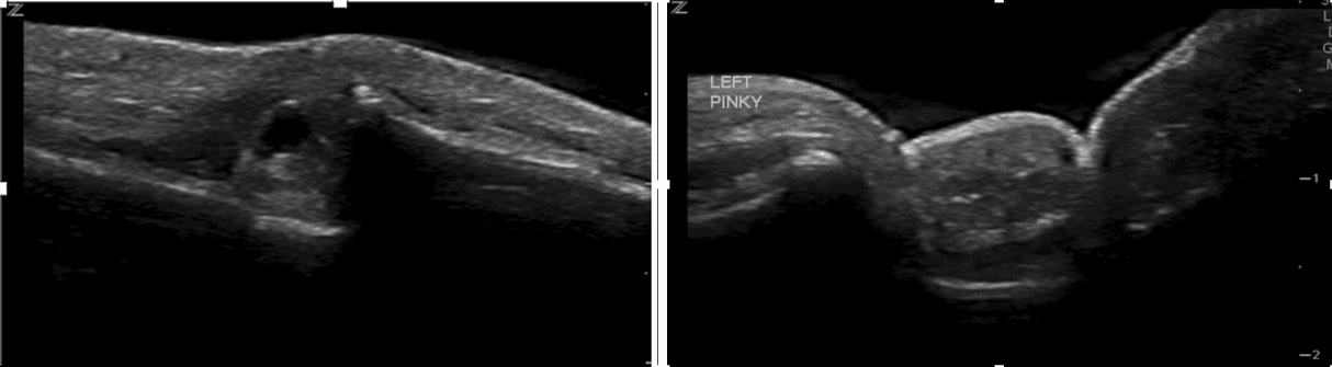 Finger dislocation on POCUS with the probe positioned dorsally (L) showing the dorsal aspect of the interphalangeal joint and ventrally (R) showing the malaligned phalangeal bones with LEFT PINKY label