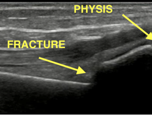 PEM POCUS Series: Pediatric Musculoskeletal Ultrasound