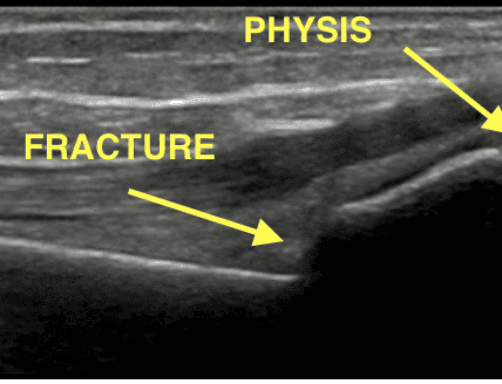 Splinter Forearm SplintER Series: Splint Application Principles 102