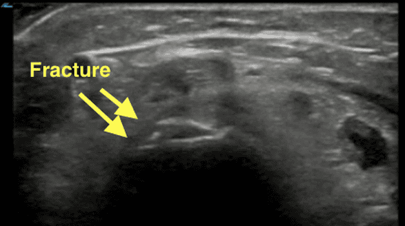 Pediatric distal radius fracture in transverse view showing irregular curvilinear bony surface with both edges of the fracture site visible