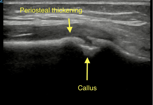 Longitudinal ultrasound of a healing distal radius fracture with periosteal thickening and callus