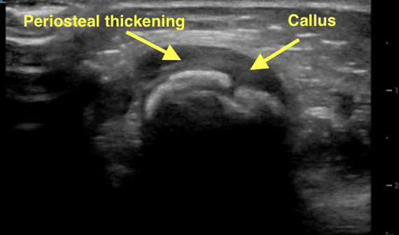 Transverse ultrasound of a healing distal radius fracture with periosteal thickening and callus