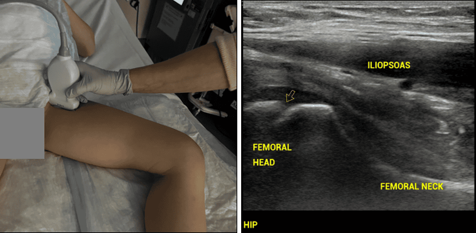 Linear ultrasound probe positioning on the anterior hip (L) and normal hip anatomy showing the femoral head with open physis, femoral neck, and iliopsoas muscle (R)