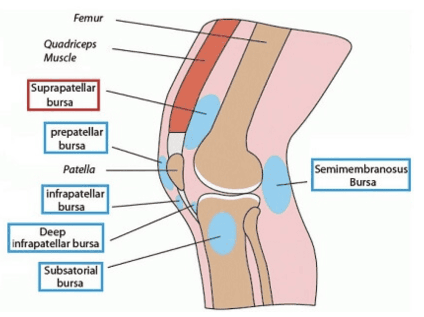 Anatomic diagram of the bursae of the knee, highlighting the suprapatellar bursa contiguous with the knee joint space