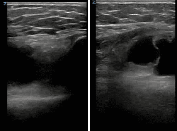Pediatric left knee POCUS composite showing suprapatellar joint effusion (L) and effusion with internal septations (R)