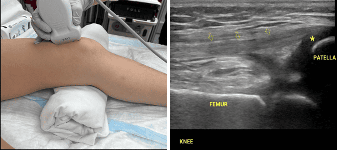 Linear probe positioning over the anterior distal femur with a towel under the knee (L) and normal knee anatomy showing quadriceps tendon, cartilage around the patella, and femur (R)