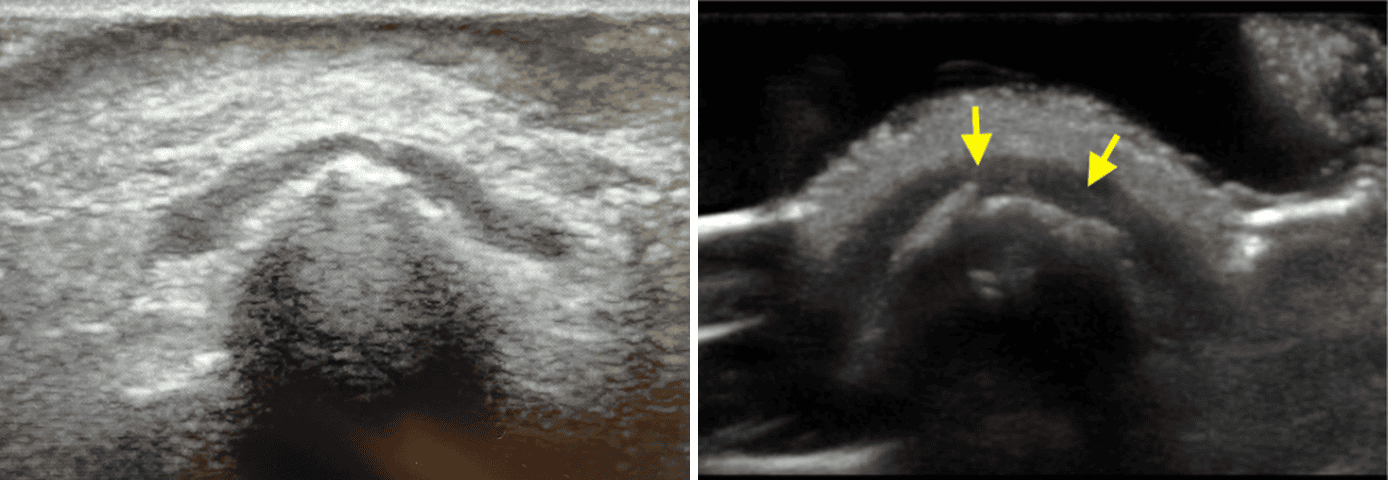 Transverse ultrasound of a normal pediatric nasal bone (L) and a pediatric nasal fracture with cortical discontinuities indicated by yellow arrows (R)