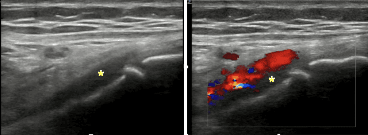 Osteomyelitis of the distal femur on POCUS showing irregular bony cortex with periosteal abscess marked by asterisk (L) and color Doppler showing increased vascular flow adjacent to the periosteal abscess (R)