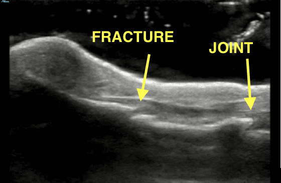 Pediatric finger phalanx fracture imaged in a water bath showing discontinuity of the bony cortex with FRACTURE and JOINT labeled