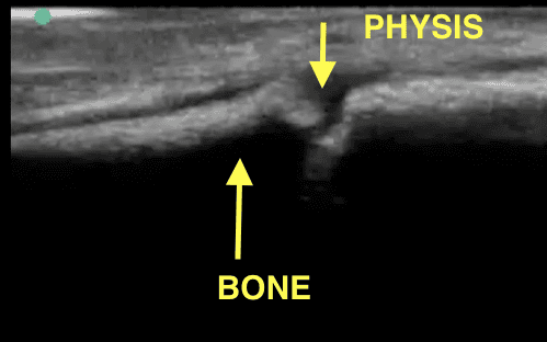 Longitudinal view of normal physis showing V-shaped hypoechoic band between metaphysis and epiphysis