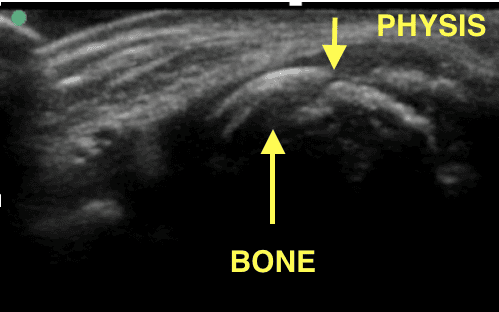 Transverse view of normal physis with regular but ragged appearance between metaphysis and epiphysis