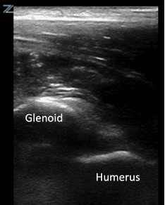 Transverse shoulder POCUS demonstrating an anterior shoulder dislocation, with the glenoid labeled in the upper portion of the image and the humerus labeled deeper, indicating anterior displacement of the humeral head away from the posteriorly placed probe