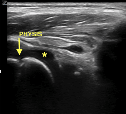 Shoulder POCUS showing a shoulder effusion with anechoic fluid (asterisk) adjacent to the humeral head, with the physis indicated by an arrow