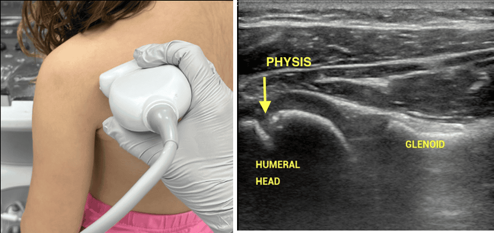 Linear ultrasound probe positioning in the transverse view over the posterior shoulder (L) and corresponding normal shoulder anatomy showing humeral head, physis, and glenoid (R)