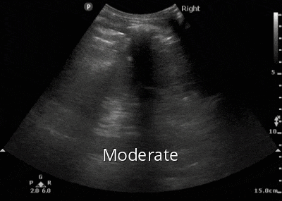 Figure 4b. Moderate hydronephrosis