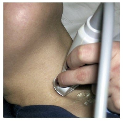 Figure 1. Transverse placement of the high-frequency linear transducer over the trachea just cephalad to the suprasternal notch.