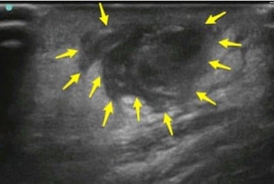 Abscess Ultrasound