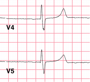 BroadQRS Hyperkalemia