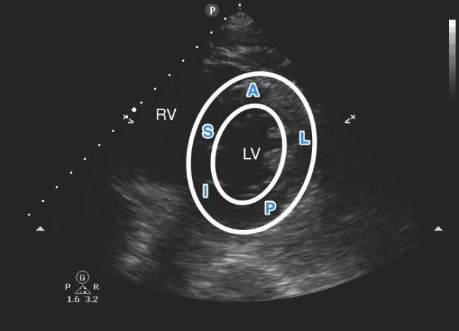 Identification of areas of the left ventricle (LV), “SALPI”: Septal (S), Anterior (A), Lateral (L), Posterior (P), Inferior (I). Right ventricle (RV) is also seen