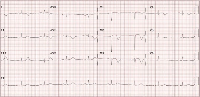 Electrocardiogram (EKG) concerning for anterior ST-elevation myocardial infarction (STEMI)