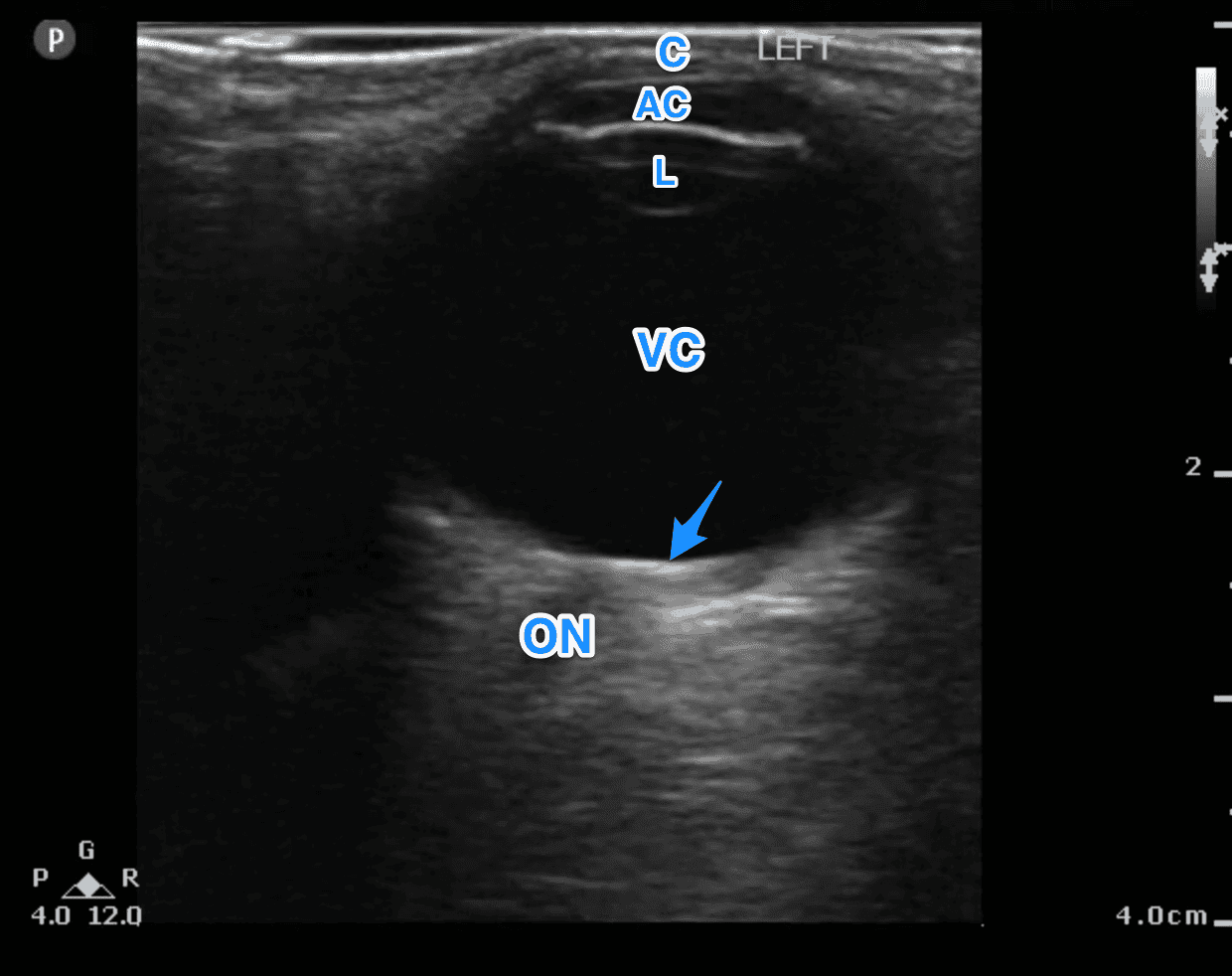 Fig 3 Normal Eye Anatomy Ultrasound