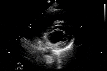 Normal parasternal short axis (PSSA) view of the heart