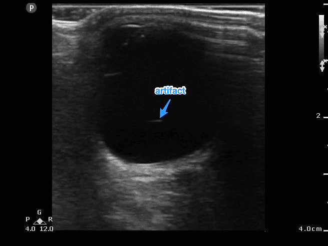 Figure 5. Artifacts can sometimes be mistaken for retinal detachment or other pathology