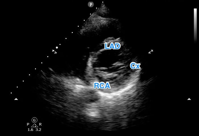 Generalized correlation of left ventricular wall regions with coronary vessels; left anterior descending (LAD), circumflex (Cx), and right coronary artery (RCA)