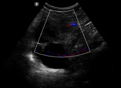 Color Doppler revealing absence of flow within the ovary and flow peripherally