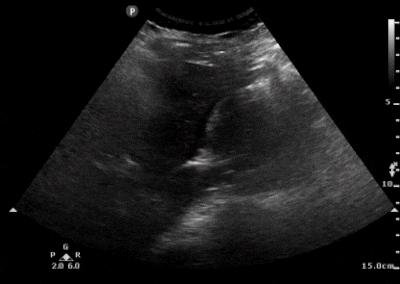 Free fluid in Morison’s Pouch, presumably from a ruptured hemorrhagic ovarian cyst