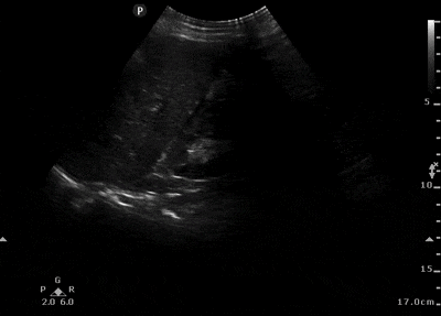 Figure 2. FAST exam reveals subtle positive free fluid in Morrison’s Pouch.