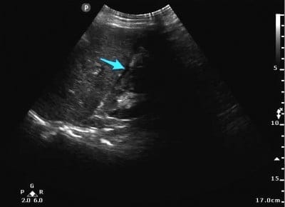 Figure 3. Free fluid (blue arrow) in Morrison’s Pouch.