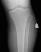 GSW leg XR