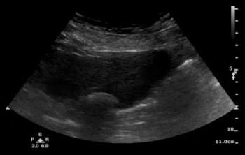 Ultrasound For The Win Case - 46F with Abdominal Pain #US4TW
