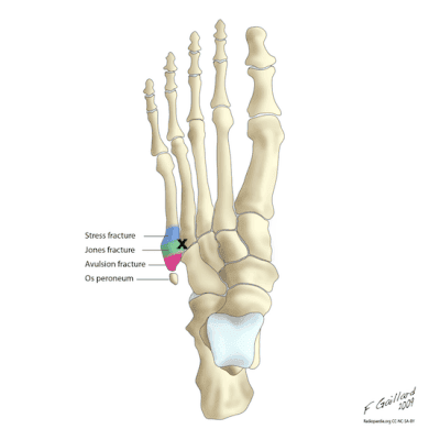 Jones Foot anatomy