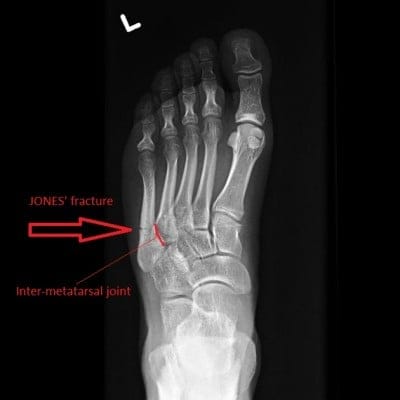 Jones fracture from Radiopedia.org
