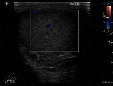 Figure 3. Normal testicular ultrasound. Note the normal homogenous echotexture and normal flow pattern with color doppler.