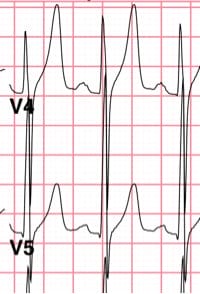 Peaked T waves