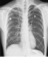 Pneumothorax-Deep-Sulcus