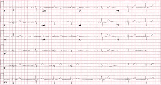 QI_ECG