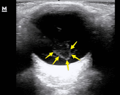 ocular ultrasound vitreous hemorrhage ultrasound