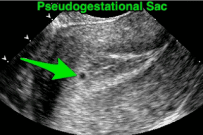 Intrauterine pregnancy first trimester ultrasound transaabdominal